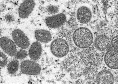 Már Magyarországon is diagnosztizáltak majomhimlős megbetegedést